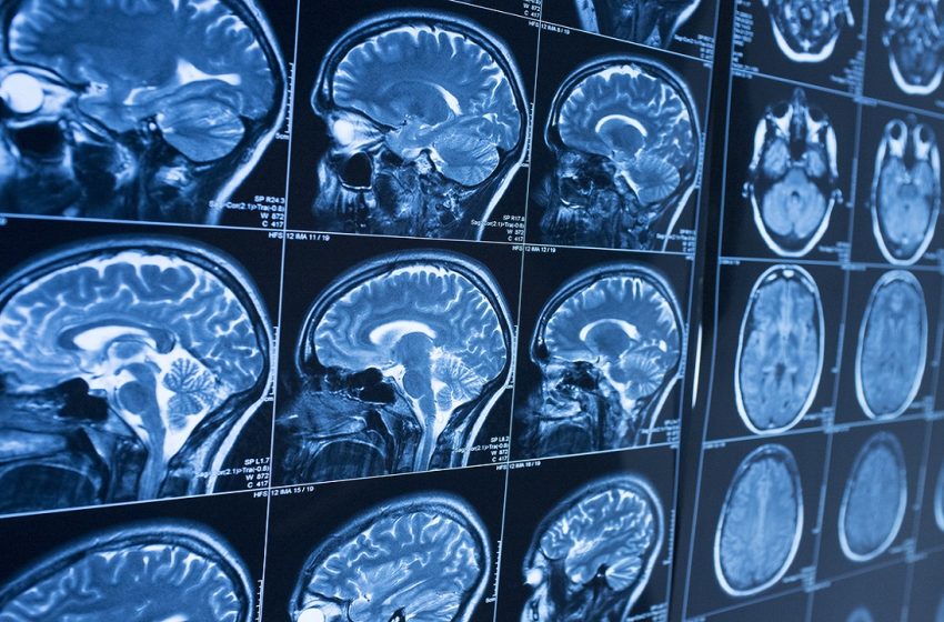  Brain scans of coronavirus patients suggest ‘significant’ grey matter loss over time: study