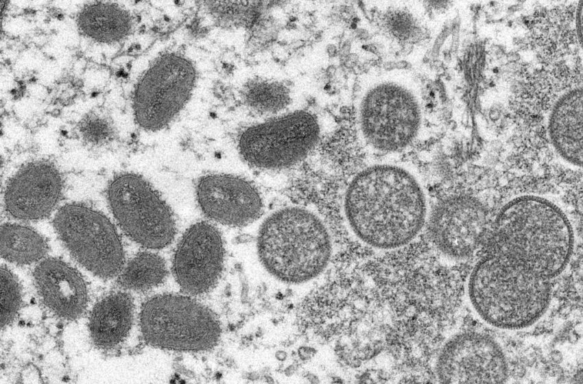  Traveler may be California’s 1st monkeypox case