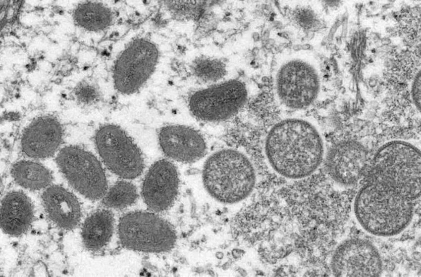  Douglas County identifies first case of monkeypox