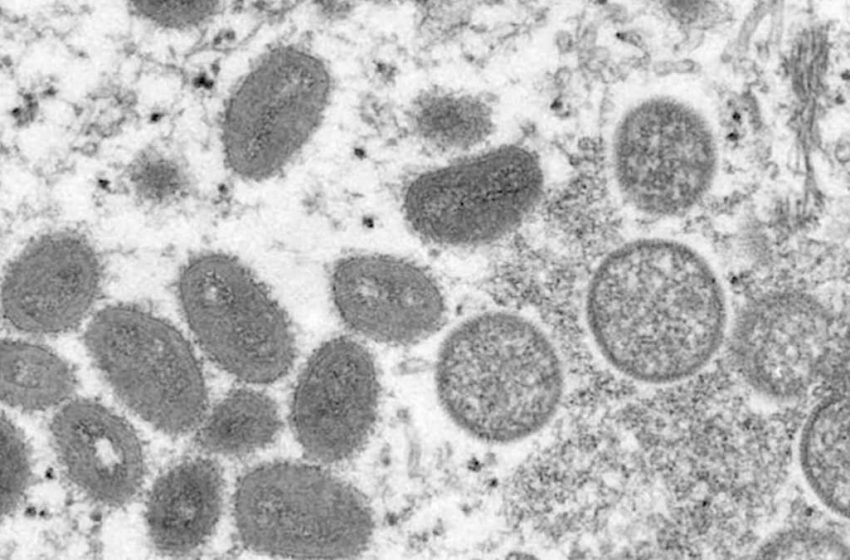 First probable case of monkeypox identified in New Hampshire